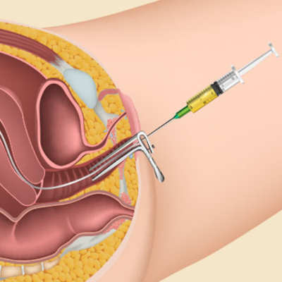 embryo transfer procedure in ivf